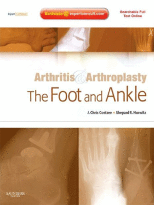 Arthritis and Arthroplasty: The Foot and Ankle