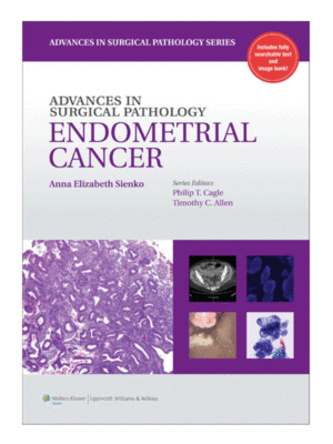Advances in Surgical Pathology: Endometrial Cancer