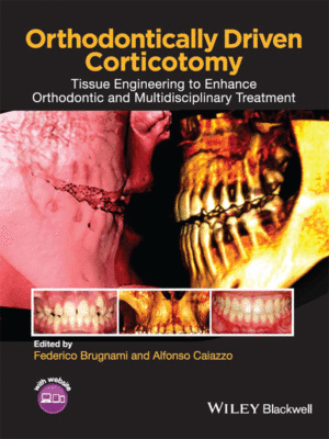 Orthodontically Driven Corticotomy