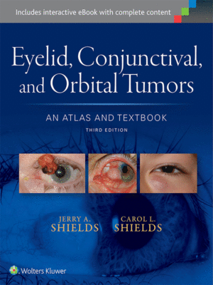 Eyelid, Conjunctival and Orbital Tumors