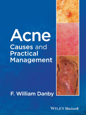 Acne: Causes and Practical Management