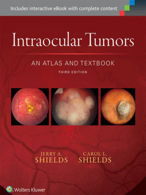 Intraocular Tumors: An Atlas and Textbook