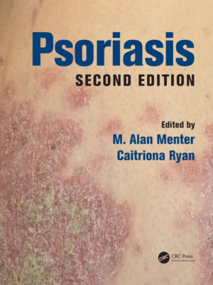 Psoriasis