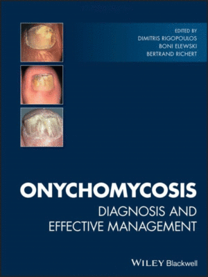 Onychomycosis by Rigopoulos