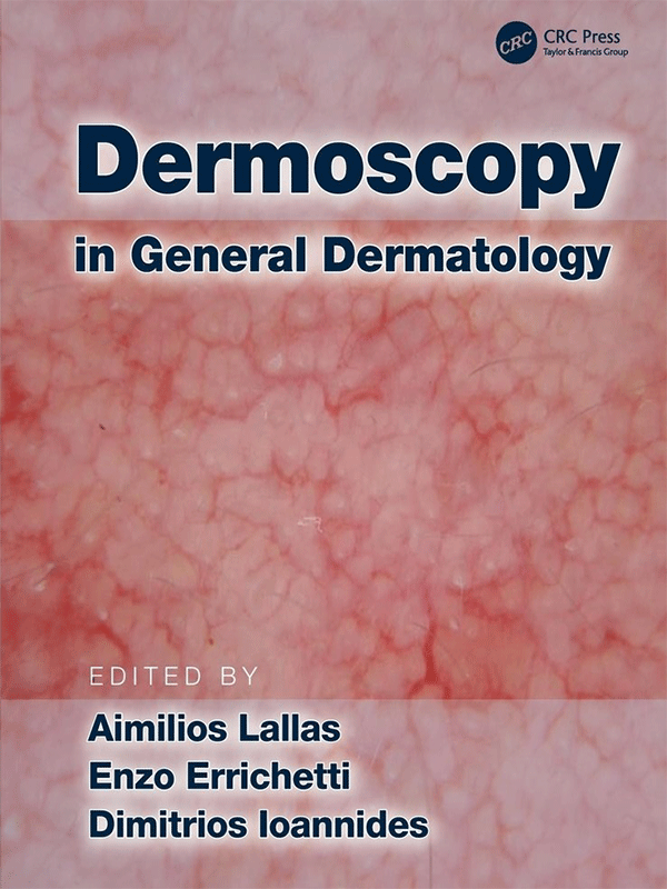 Dermoscopy in General Dermatology by Lallas, Errichetti & Ioannides