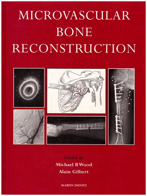 Microvascular Bone Reconstruction by Wood & Gilbert Microvascular Bone Reconstruction by Wood & Gilbert