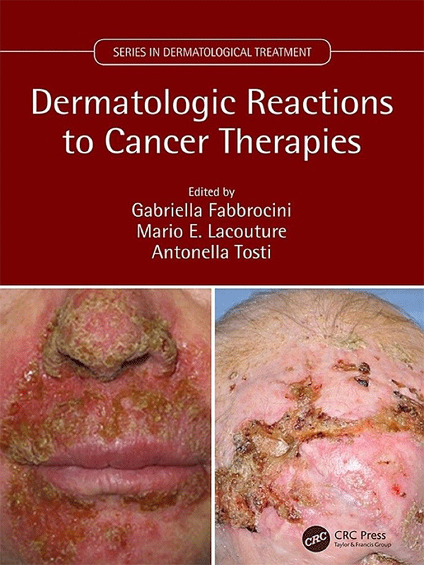 Dermatologic Reactions to Cancer Therapies Dermatologic Reactions to Cancer Therapies