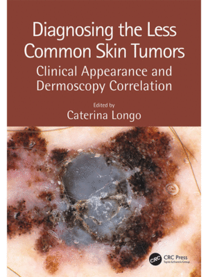 Diagnosing the Less Common Skin Tumors