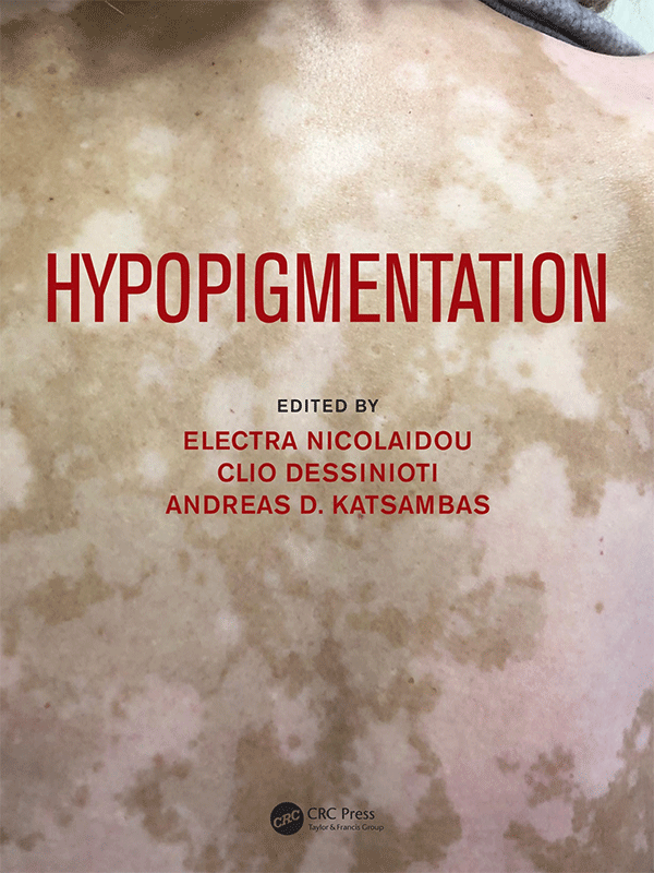 Hypopigmentation by Nicolaidou, Dessinioti & Katsambas Hypopigmentation by Nicolaidou, Dessinioti & Katsambas