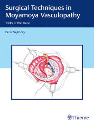 Surgical Techniques in Moyamoya Vasculopathy