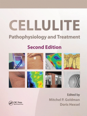 Cellulite: Pathophysiology and Treatment, 2nd Edition