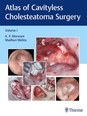 Atlas of Cavityless Cholesteatoma Surgery, Volume 1
