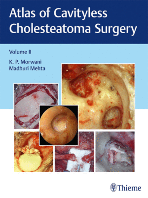 Atlas of Cavityless Cholesteatoma Surgery, Volume 2