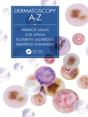 Dermatoscopy A-Z by Lallas