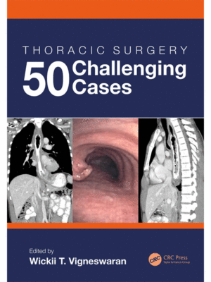 Thoracic Surgery: 50 Challenging Cases