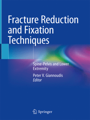Fracture Reduction and Fixation Techniques by Giannoudis: Spine-Pelvis and Lower Extremity