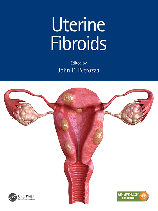 Uterine Fibroids Uterine Fibroids
