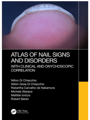Atlas of Nail Signs and Disorders with Clinical and Onychoscopic Correlation