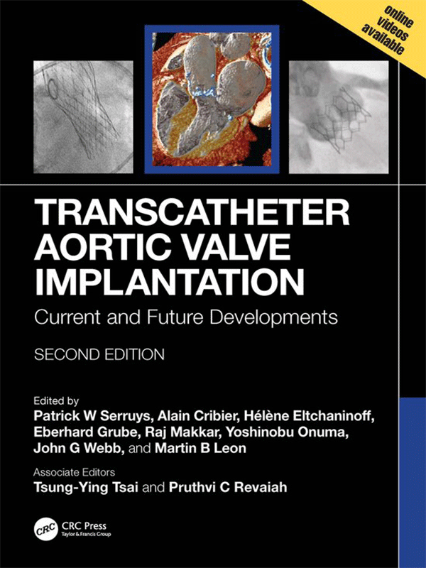 Transcatheter Aortic Valve Implantation: Current and Future Developments, 2nd Edition Transcatheter Aortic Valve Implantation: Current and Future Developments, 2nd Edition